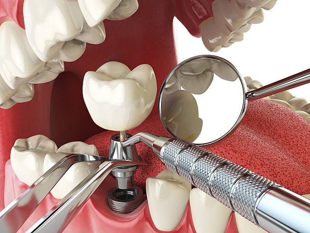 Best Emergency Dentist for Lost Fillings or Crowns in Tonkawa, OK